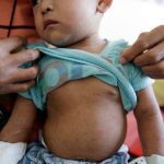 measles outbreak