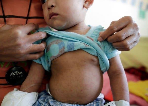 measles outbreak