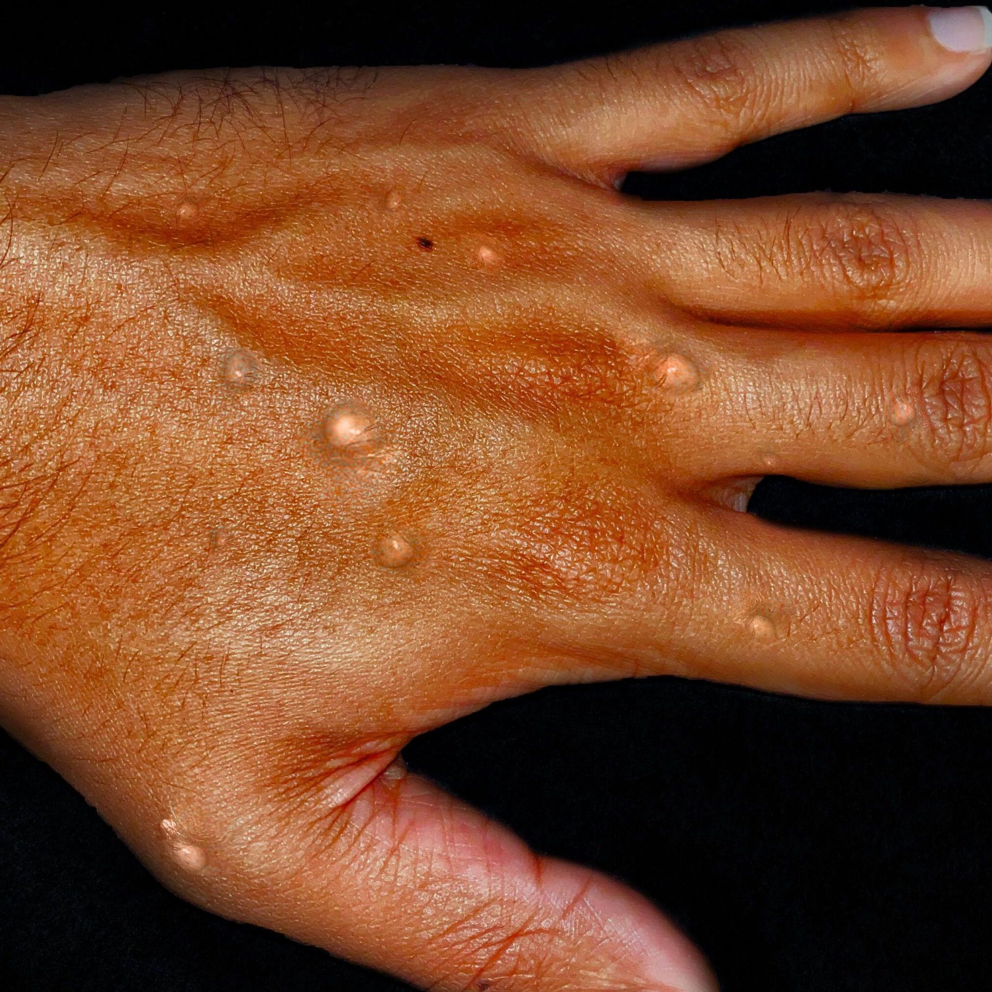 South Africa’s Department of Health is urging public vigilance after a rapid rise in laboratory-confirmed mpox cases, with 18 confirmed cases and one probable case recorded as of 17 September 2026.